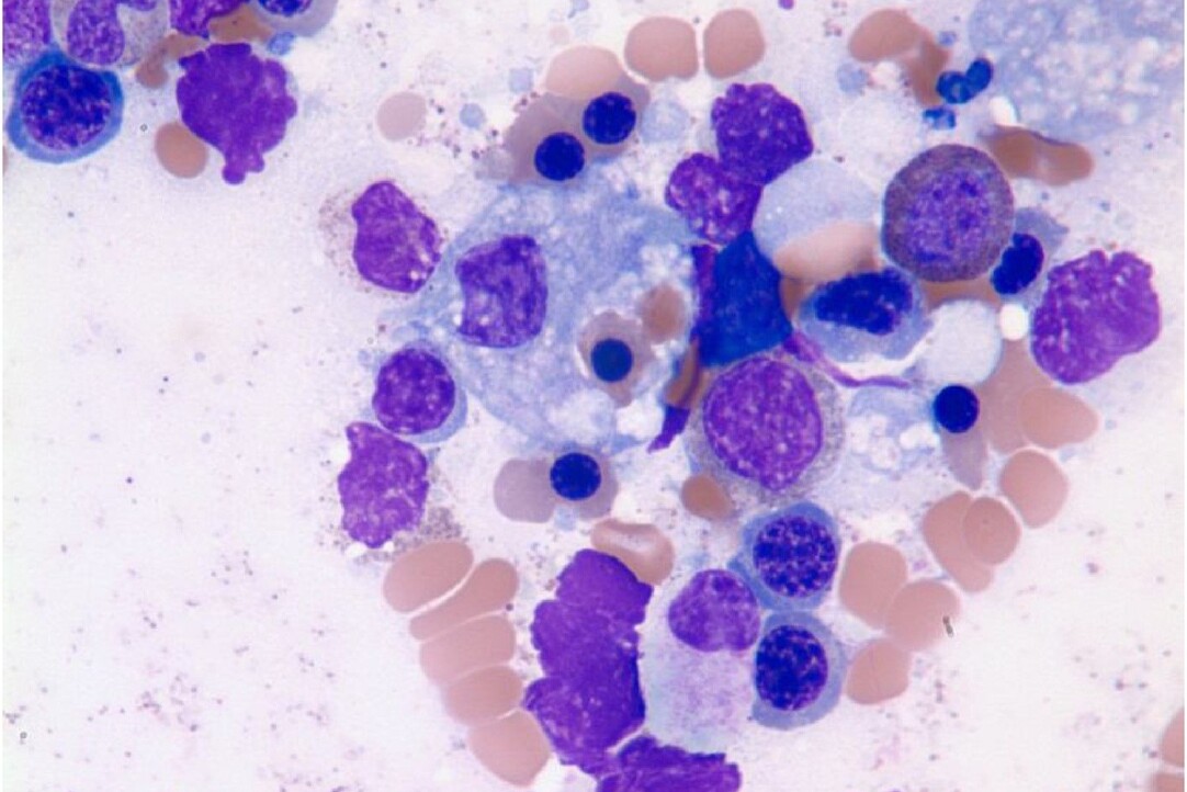Иллюстрация к новости: Гемофагоцитарный синдром и макрофаги